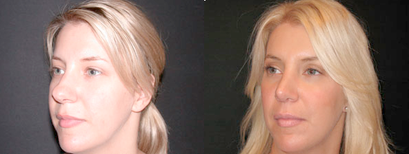 Newport Beach Rhinoplasty